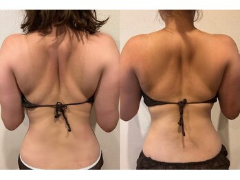 ユー 喜連西店(U)/脂肪冷却【before after】