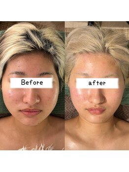 ウル 下北沢(Ulu)/頭蓋骨小顔矯正8回