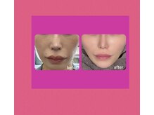 メディカルサロン レムリア/こけた頬もふっくら