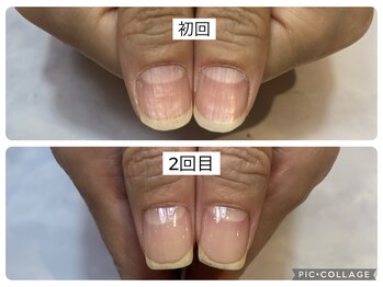 アンドネイル 海老名(&nail)/1回の変化です