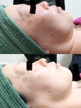 サロン ド 花歩 松山本店/最速の肌変☆Nハーブピーリング