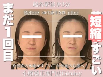 ジェイミー(Gemiey)/１回で劇的短縮！！