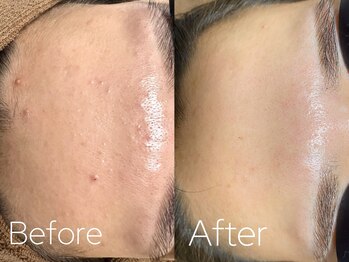 バーニー 梅田店(BARNEY)/ハーブピーリング