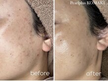 パールプラス 小牧店(Pearl plus)/BeforeAfter