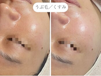 フラックス 京都(FLUX)/【ワックス脱毛】フェイシャル