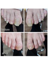 爪切り屋 足楽/【巻き爪】