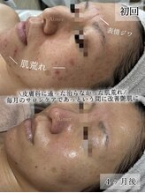 エメ(Aimer)/40代：肌改善