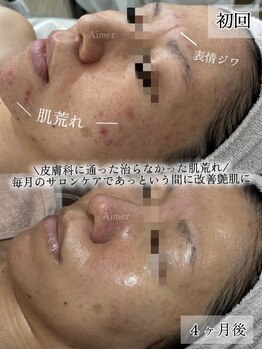エメ(Aimer)/40代：肌改善