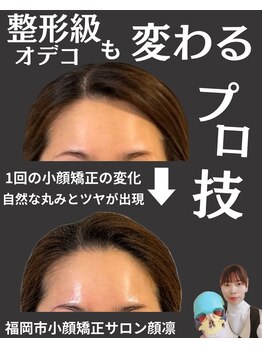 顔凛(カオリン)/オデコも変わる小顔矯正