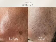 ベルダ(BELDAD)/【シミケアBefore After】