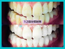 ミルクホワイトニング 長崎中央橋店(Milkホワイトニング)/◆施術例