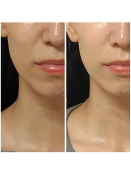 エターナル(Eternal)の写真/【大人たるみケアに★夢の糸Deリフトアップ】ほうれい線、たるみ、二重あごなどのお悩み改善に！