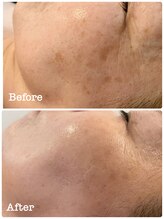 ミラ(Mila)/お肌改善　BeforeAfter