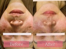 フローラ(FLORA)/シミケアBeforeAfter