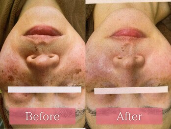 フローラ(FLORA)/シミケアBeforeAfter