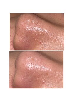 ディシェーレ アスト/ハイドロフェイシャル