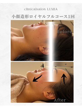 ルミア(LUMIA)/小顔造形ロイヤルフルコース１回