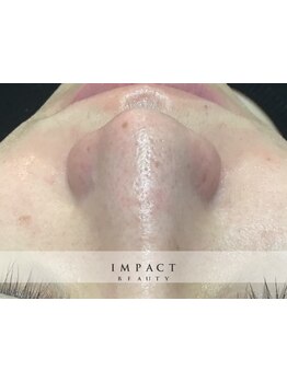 毛穴ケアをしたい