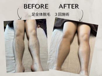 ワンアップ(One-up)/足全体脱毛 ３回　before  after