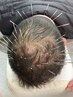 【育毛促進鍼（５０本コース）】髪毛が細くなった・髪のボリュームが減った方