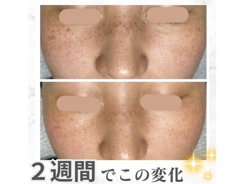 美人/シミケア15分の効果