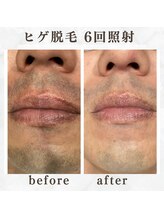 ボゴス(BOGOSS)/ヒゲ脱毛６回照射