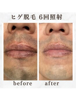 ボゴス(BOGOSS)/ヒゲ脱毛6回照射