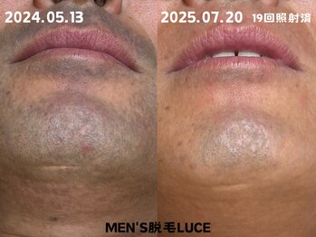 ルーチェ/【髭脱毛】印象upまずは髭から