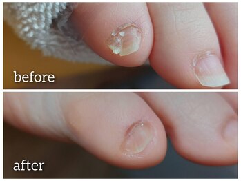 【悩ましい小指の爪】