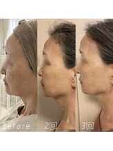 カロン(Kalon)/切らずにリフトUP♪リフェイス