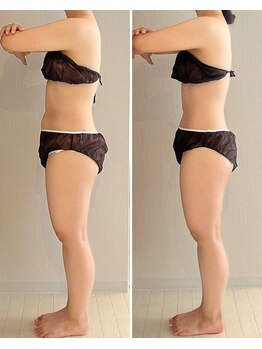 ヒールプラス(heal+)/5回コース、before→after