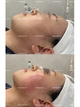 ナラビューティー(NARA BEAUTY)/韓国最新オンタリフト導入!