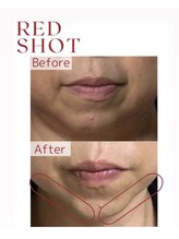 レクレア/レッドショットで速攻小顔