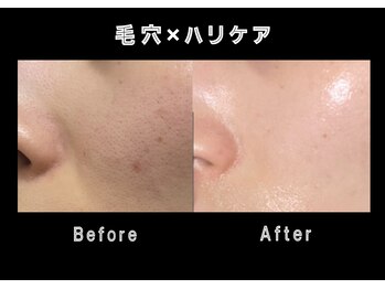 エステティック レイビス 銀座店(RAYVIS)/ホワイトスノーピール