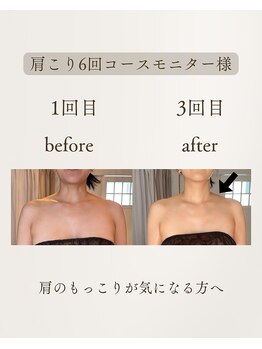 きぃ オリジンプラス(きぃ origin+)/肩のもっこり改善