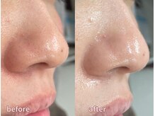 ミレット(Miretto)/【敏感肌】水光ピーリング