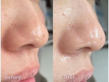 ミレット(Miretto)/【敏感肌】水光ピーリング