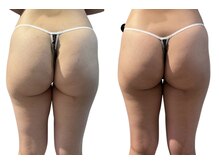 痩せラボ/引き上げ【痩身】