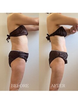 ブルーム(BLOOM)/上半身痩身3ヶ月コース