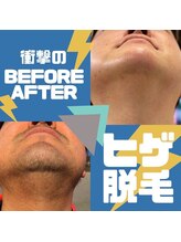 アトレ(Atre)/脱毛奇跡！お髭&肌の変化！