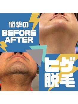 アトレ(Atre)/脱毛奇跡！お髭&肌の変化！