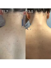 ルシェリア(Le cherien)/背中ケア！効果実感が早い