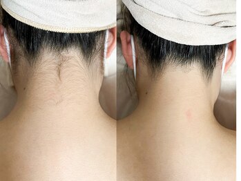 ウルオイ 海老名(URUoi)/脱毛Before→After