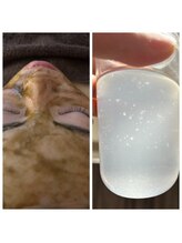 エルモア(L-MORE)/毛穴洗浄×ハーブピーリング