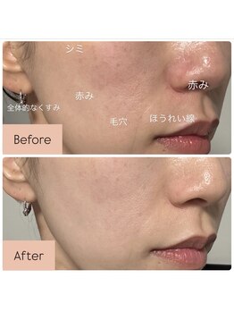 ラグ(LUXU)/韓国美容シェアNo. 1、光美容♪