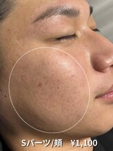 カナウ(KANAU)/【Sパーツ/脱毛】頬