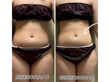 クールスパ(COOL SPA)/【20代女性】お腹症例