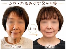 ルル 北仙台の雰囲気(ビフォーアフター、2ヶ月後ハリ、透明感アップ◎)