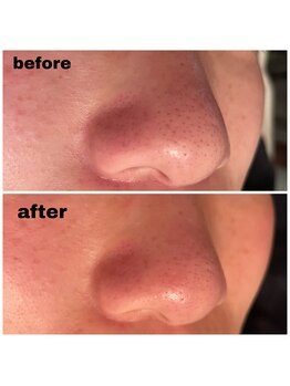 ウイユサロン(oeilsalon)/毛穴集中トリートメント