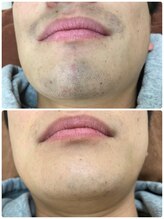 ビューティーグロウ(BEAUTY-GROW)/ヒゲ脱毛